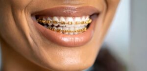 lakewood orthodontics