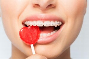 Top 5 Lakewood Braces Eating Tips