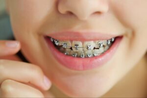 What Parents Should Know About Braces and Aligners