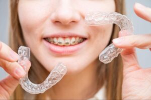 What Parents Should Know About Braces and Aligners
